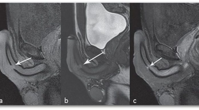 Скршен пенис – скршено машко достоинство