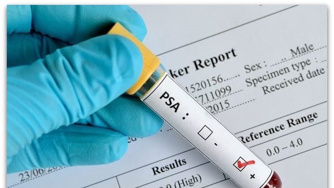 ПРОСТАТА – што треба да знаете за ПСА тестот?