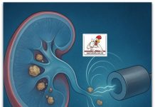 Крај на бескрајните болни процедури ? Измислен е нов, многу темелен метод за отстранување на бубрежни камења