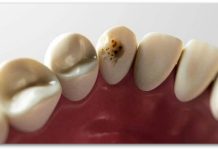 Крај на кариесот и пломбите ? Револуционерен гел ја обновува забната глеѓ