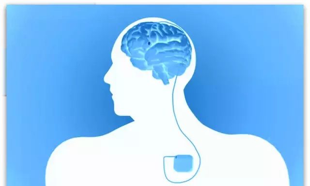 „Мозочен пејсмејкер“ решава еден од најтешките случаи на депресија – пациентот заплакал од среќа